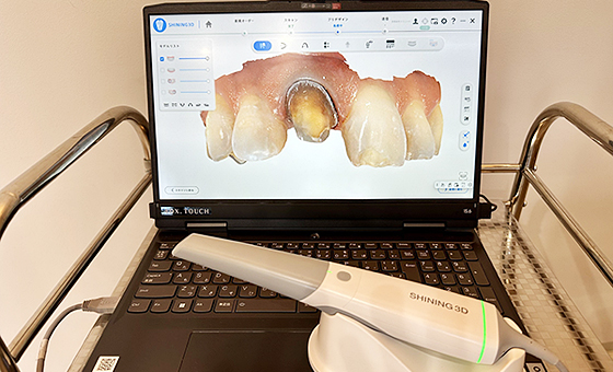 口腔内スキャナー